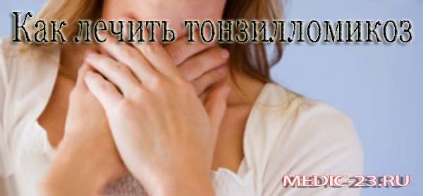 Тонзилломикоз: как лечить?